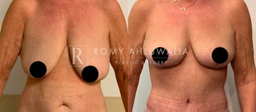 Before & After Result of Breast Reduction Patient #26