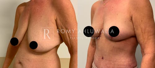 Before & After Result of Breast Reduction Patient #26
