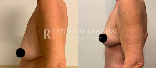 Before & After Result of Breast Reduction Patient #26