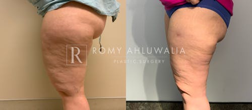 Before & After Result of Liposuction Patient #2