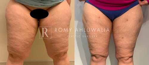 Before & After Result of Liposuction Patient #2