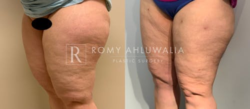 Before & After Result of Liposuction Patient #2