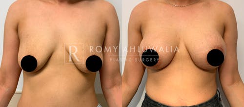 Before & After Result of Breast Augmentation With Lift Patient #2