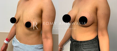 Before & After Result of Breast Augmentation With Lift Patient #2
