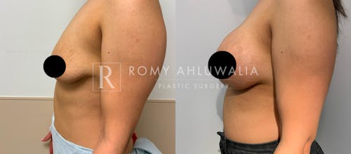 Before & After Result of Breast Augmentation With Lift Patient #2