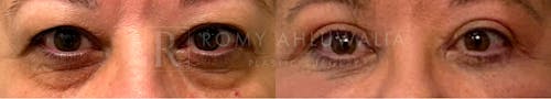 Before & After Result of Upper & Lower Eyelid Surgery Patient #13