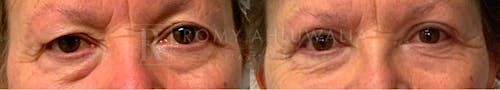 Before & After Result of Upper & Lower Eyelid Surgery Patient #14