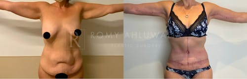 Before & After Result of Arm Lift Patient #3