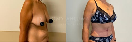 Before & After Result of Arm Lift Patient #3