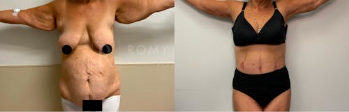 Before & After Result of Arm Lift Patient #4