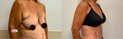 Before & After Result of Arm Lift Patient #4