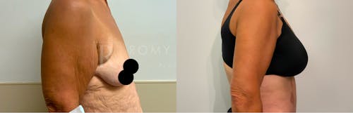 Before & After Result of Arm Lift Patient #4