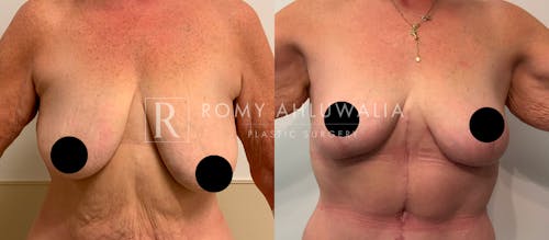 Before & After Result of Breast Reduction Patient #34