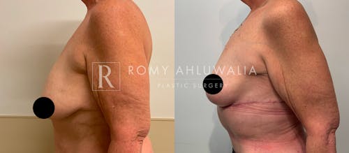 Before & After Result of Breast Reduction Patient #34