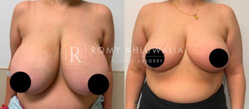Before & After Result of Breast Reduction Patient #24
