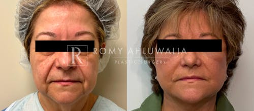 Before & After Result of Facelift Patient #19