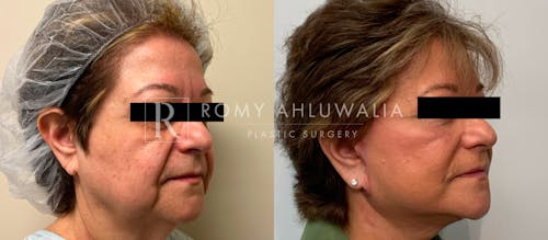 Before & After Result of Facelift Patient #19