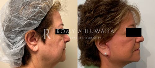 Before & After Result of Facelift Patient #19
