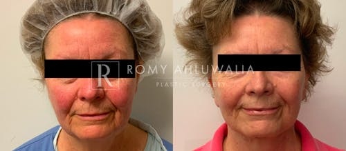 Before & After Result of Facelift Patient #20