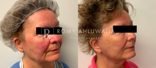 Before & After Result of Facelift Patient #20