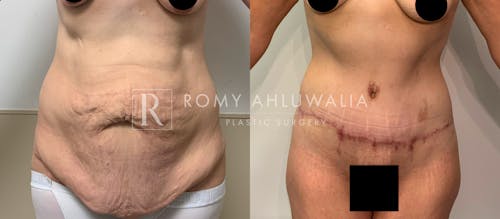 Before & After Result of Tummy Tuck Patient #65