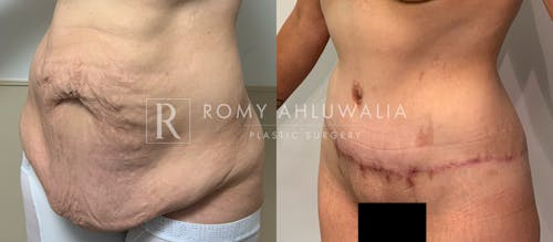 Before & After Result of Tummy Tuck Patient #65