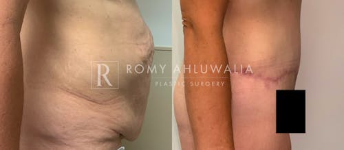 Before & After Result of Tummy Tuck Patient #65