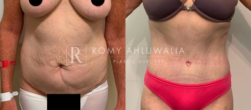 Before & After Result of Tummy Tuck Patient #66