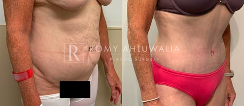 Before & After Result of Tummy Tuck Patient #66
