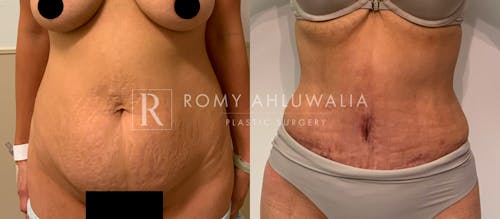 Before & After Result of Tummy Tuck Patient #67