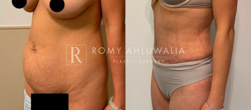 Before & After Result of Tummy Tuck Patient #67
