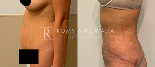 Before & After Result of Tummy Tuck Patient #67