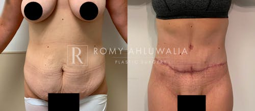 Before & After Result of Tummy Tuck Patient #68