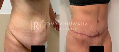 Before & After Result of Tummy Tuck Patient #68