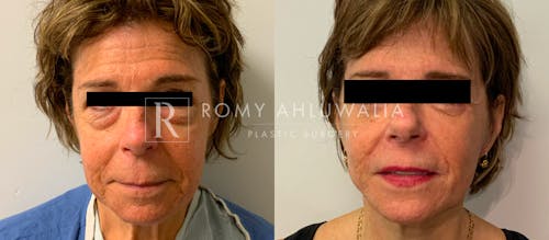 Before & After Result of Facelift Patient #21