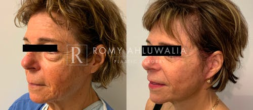 Before & After Result of Facelift Patient #21