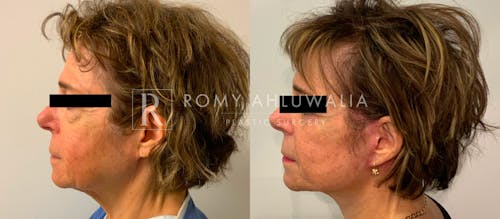 Before & After Result of Facelift Patient #21