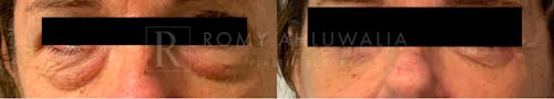 Before & After Result of Lower Eyelid Surgery Patient #15