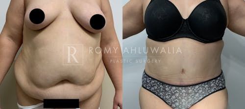 Before & After Result of Tummy Tuck Patient #69