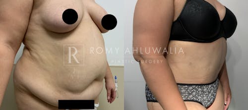 Before & After Result of Tummy Tuck Patient #69