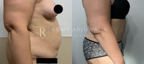 Before & After Result of Tummy Tuck Patient #69