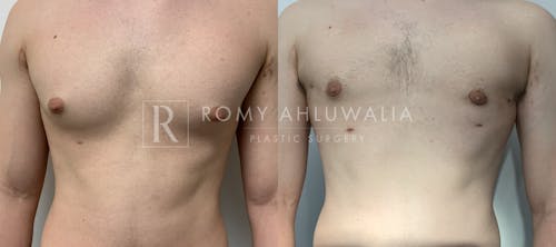 Before & After Result of Gynecomastia Patient #5