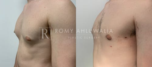 Before & After Result of Gynecomastia Patient #5