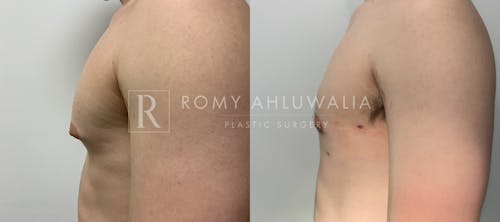 Before & After Result of Gynecomastia Patient #5
