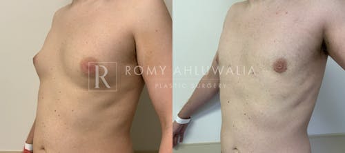 Before & After Result of Gynecomastia Patient #4