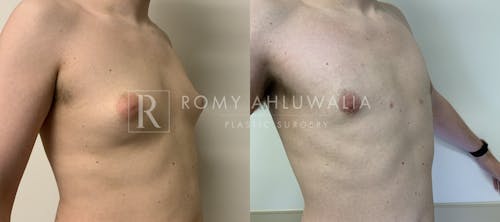 Before & After Result of Gynecomastia Patient #4