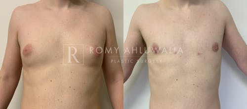 Before & After Result of Gynecomastia Patient #4