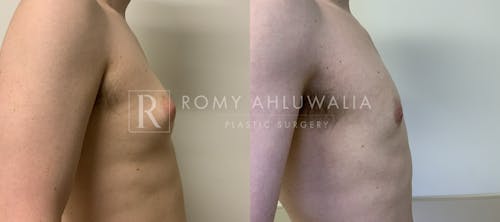 Before & After Result of Gynecomastia Patient #4