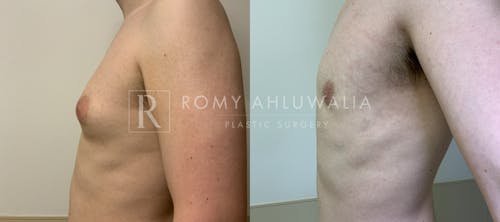 Before & After Result of Gynecomastia Patient #4