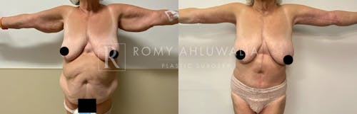 Before & After Result of Arm Lift Patient #5